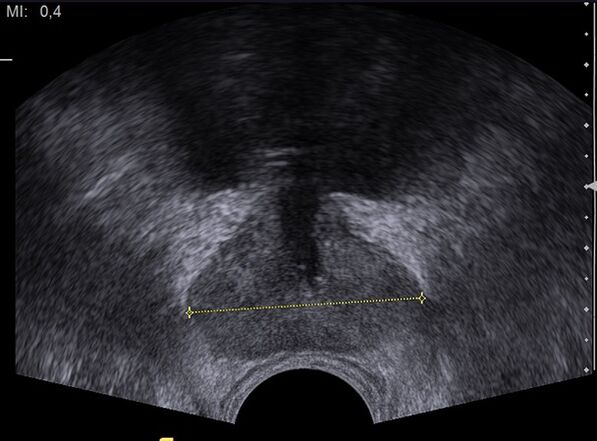 healthy prostate on ultrasound after taking Predstonorm